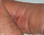 incontinentia pigmenti