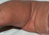 incontinentia pigmenti