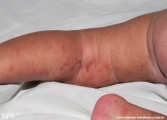 incontinentia pigmenti