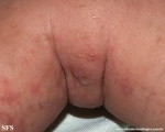 incontinentia pigmenti