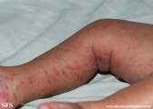 incontinentia pigmenti