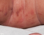 incontinentia pigmenti