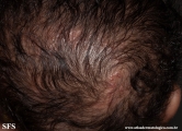 incontinentia pigmenti