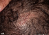incontinentia pigmenti