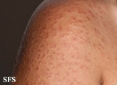 granuloma annulare-disseminated granuloma annulare