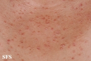 granuloma annulare-disseminated granuloma annulare