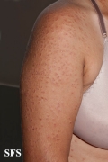 granuloma annulare-disseminated granuloma annulare