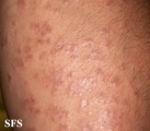 granuloma annulare-disseminated granuloma annulare