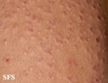 granuloma annulare-disseminated granuloma annulare