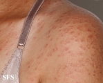granuloma annulare-disseminated granuloma annulare