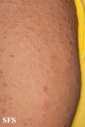 granuloma annulare-disseminated granuloma annulare