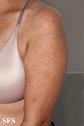 granuloma annulare-disseminated granuloma annulare