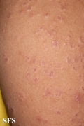 granuloma annulare-disseminated granuloma annulare