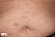 granuloma annulare-disseminated granuloma annulare