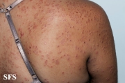 granuloma annulare-disseminated granuloma annulare