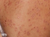 granuloma annulare-disseminated granuloma annulare