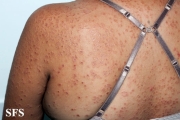 granuloma annulare-disseminated granuloma annulare