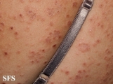 granuloma annulare-disseminated granuloma annulare