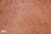 granuloma annulare-disseminated granuloma annulare