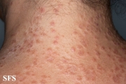 granuloma annulare-disseminated granuloma annulare
