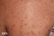 granuloma annulare-disseminated granuloma annulare
