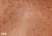 granuloma annulare-disseminated granuloma annulare
