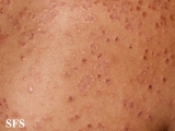 granuloma annulare-disseminated granuloma annulare