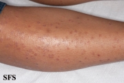 granuloma annulare-disseminated granuloma annulare