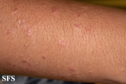 granuloma annulare-disseminated granuloma annulare