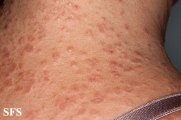granuloma annulare-disseminated granuloma annulare