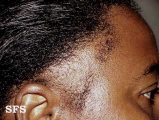 traction-traumatic alopecia