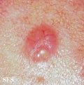 sebaceous carcinoma