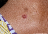 sebaceous epithelioma