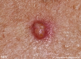 sebaceous epithelioma