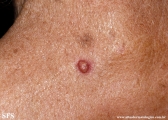 sebaceous epithelioma