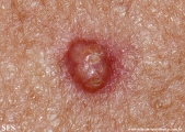 sebaceous epithelioma