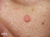 sebaceous epithelioma