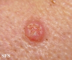 sebaceous epithelioma