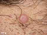 sebaceous epithelioma
