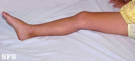 cutis marmorata telangiectatica congenita