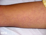 cutis marmorata telangiectatica congenita
