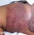 cutis marmorata telangiectatica congenita