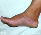 acrokeratoelastoidosis