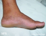 acrokeratoelastoidosis