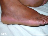 acrokeratoelastoidosis