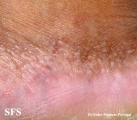 acrokeratoelastoidosis