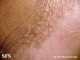 acrokeratoelastoidosis