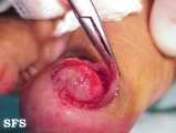 cirsoid aneurysm