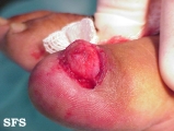 cirsoid aneurysm
