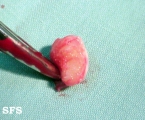 cirsoid aneurysm